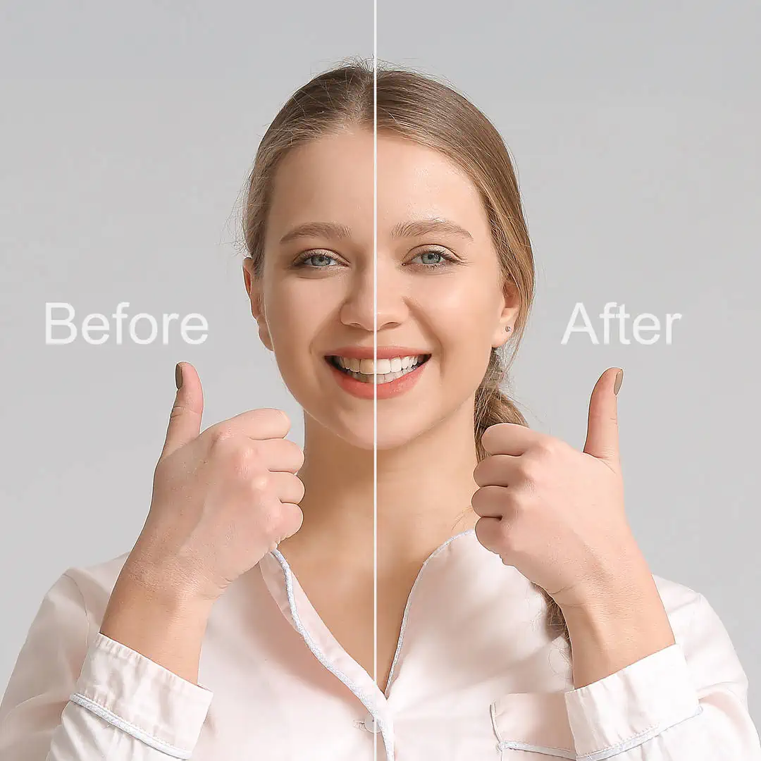 Adult patient with a straightened smile after Invisalign