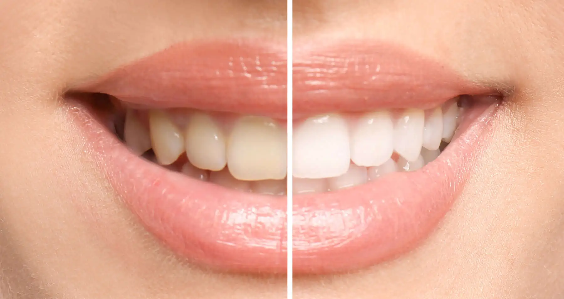 Custom take-home whitening trays included with Invisalign treatment