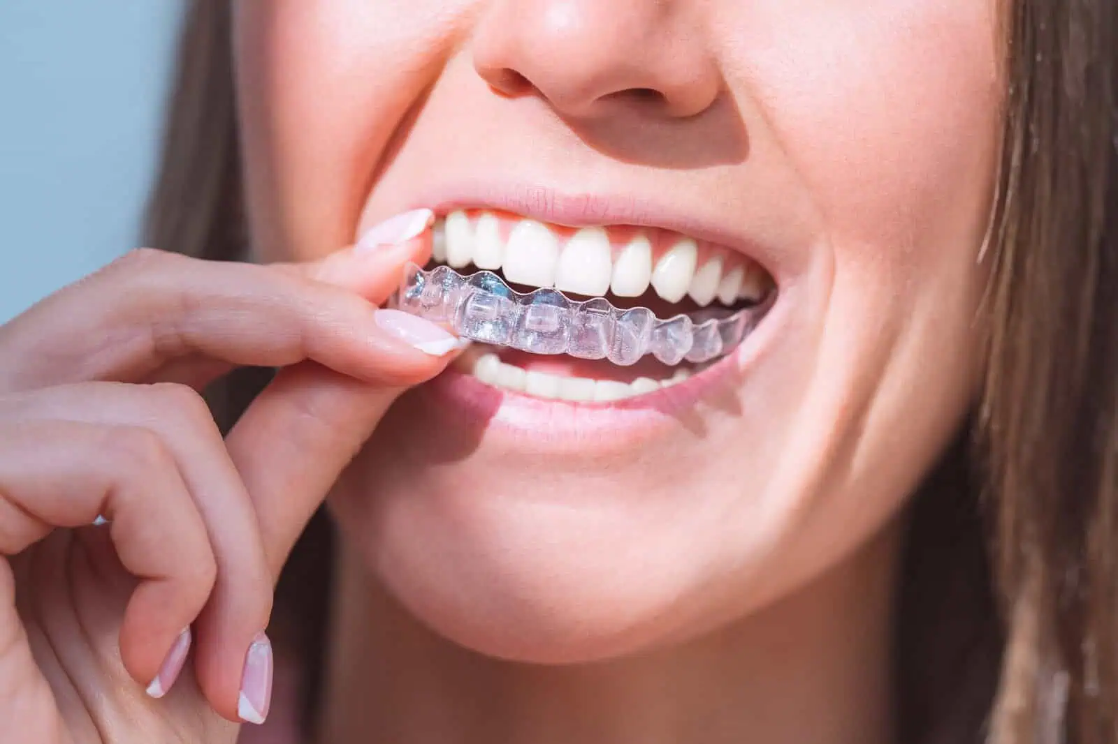 Patient wearing clear Invisalign aligners