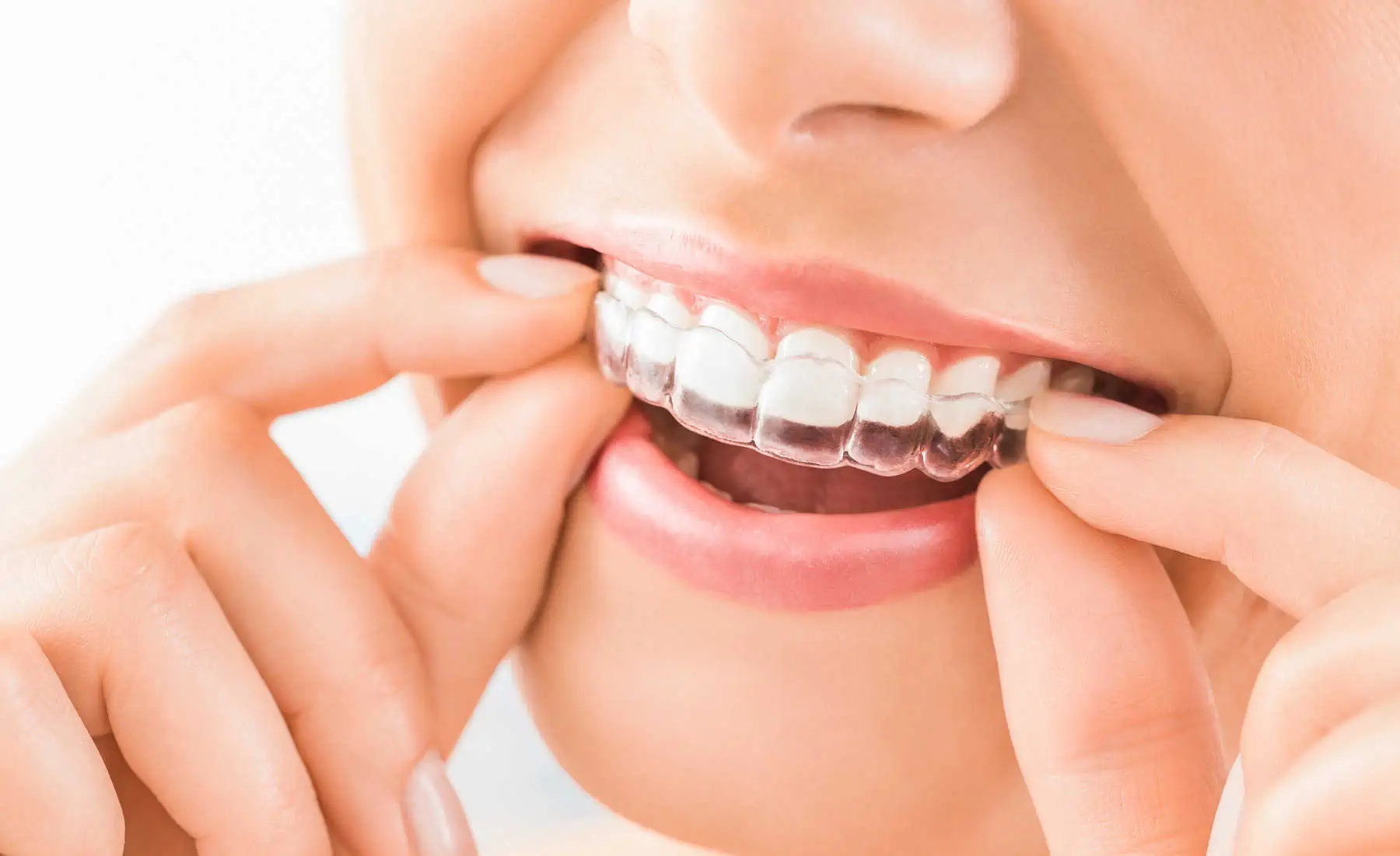 Invisalign clear aligner held by a patient