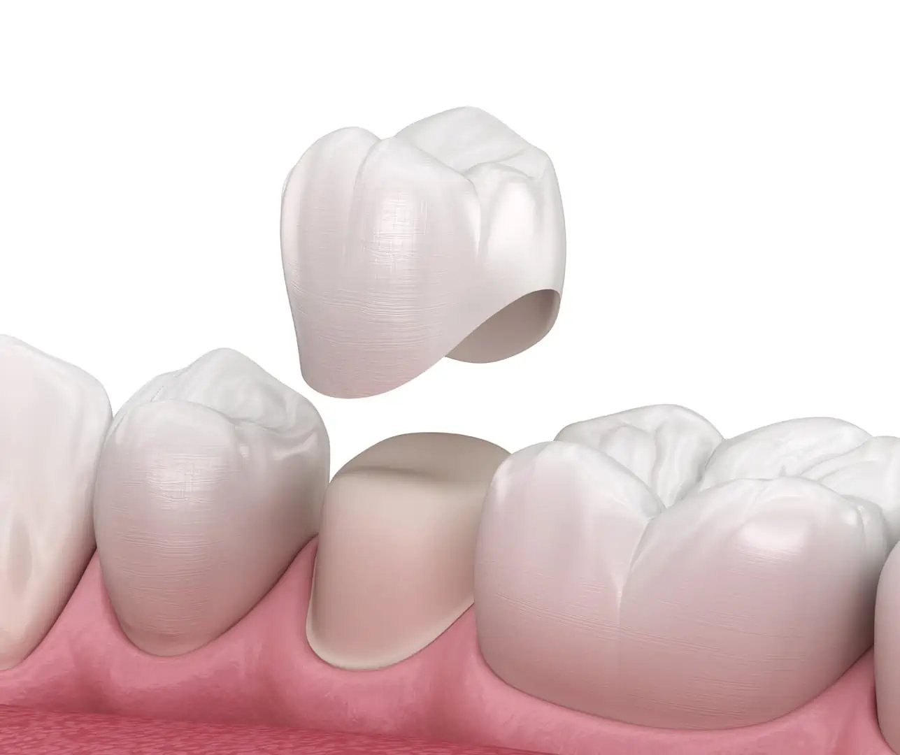 Custom porcelain dental crown restoration